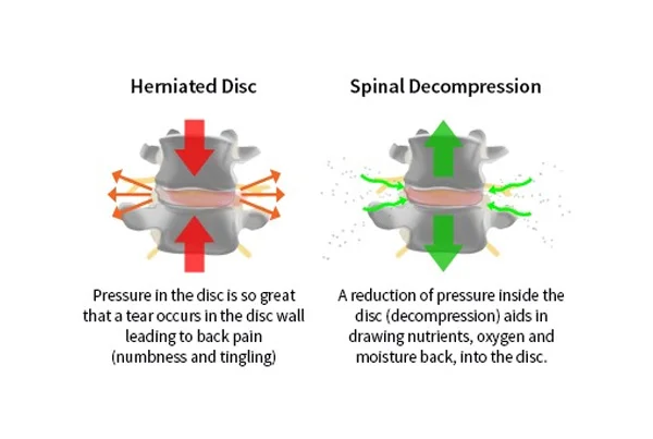 Spinal Decompression/Traction